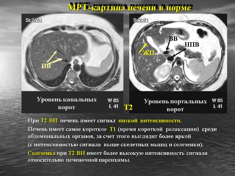 МРТ-картина печени в норме При Т2 ВИ  печень имеет сигнал  низкой 